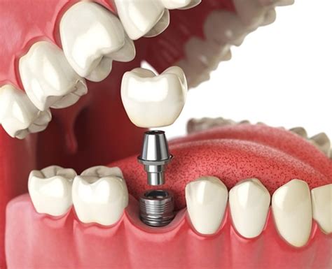 Diş implant yasaklanan ülkeler